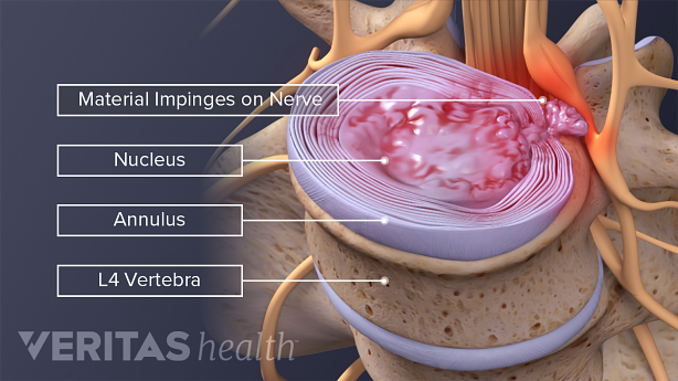 Illustration showing lumbar herniated disc.