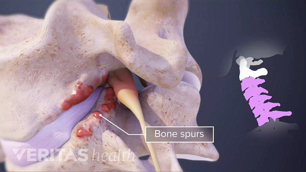 Illustration of cervical vertebra showing bone spurs and cervical spine highlighted in pink.