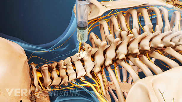 Illustration showing injection injected into the cervical spine.