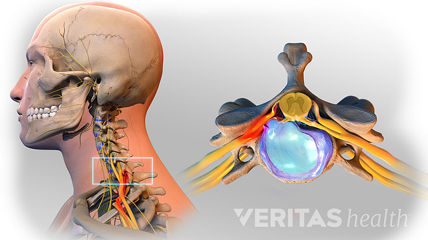 Medical illustration showing a cervical herniated disc.