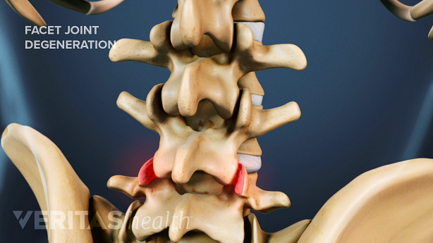 Illustration showing lumbar spine with facet joint highlighted in red.