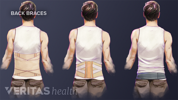 An illustration showing different types of back braces.
