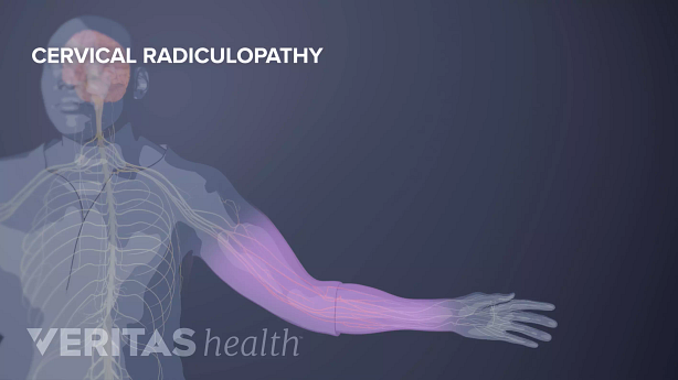 MRI style image highlighting cervical radiculopathy.
