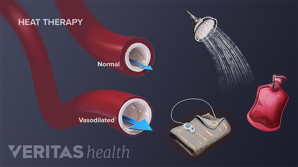 Different types of modalities used for heat therapy.