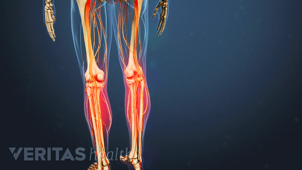 An illustration showing weakness and loss of function in legs.