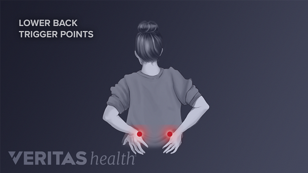 An illustration showing axial pain in low back area.
