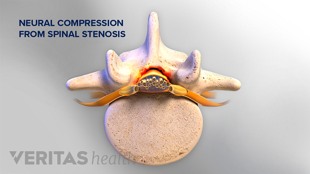Illustration showing lumbar spianl stenosis.