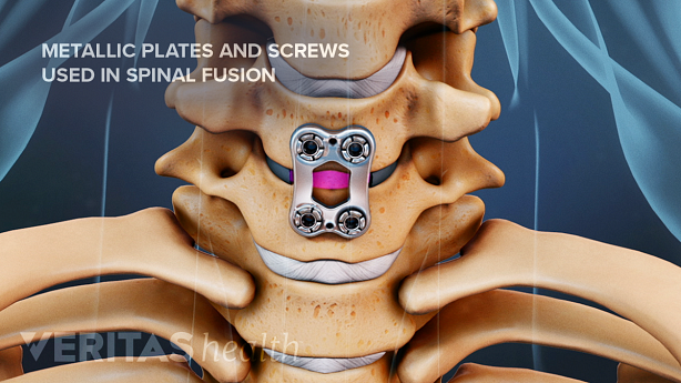 Illustration showing metal plates and screws in the cervical vertebra.