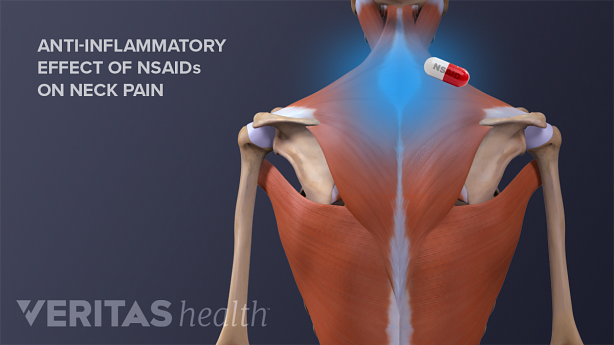 Posterior view image of back muscles and bones with an anti-inflammatory pill.