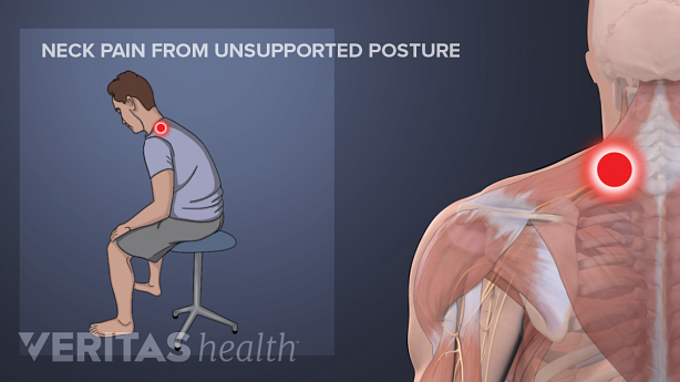 Illustration showing a man sitting slouching and a model with a triiger point in red in the neck region.