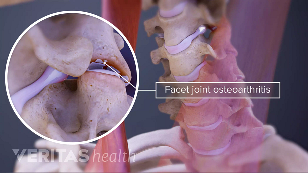 Illustration showing cervical facet joint osteoarthritis.