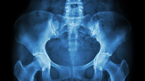 Illustration showing x-ray of pelvis and lumbar region.
