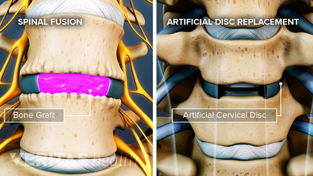 Illustration showing spinal fusion and artificial disc replacement.