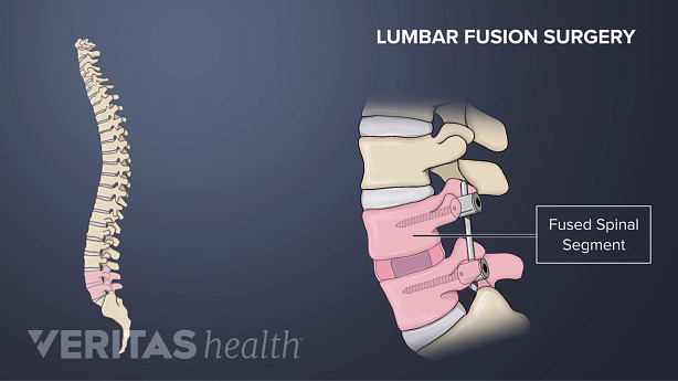 An illustration showing lumbar fusion surgery.