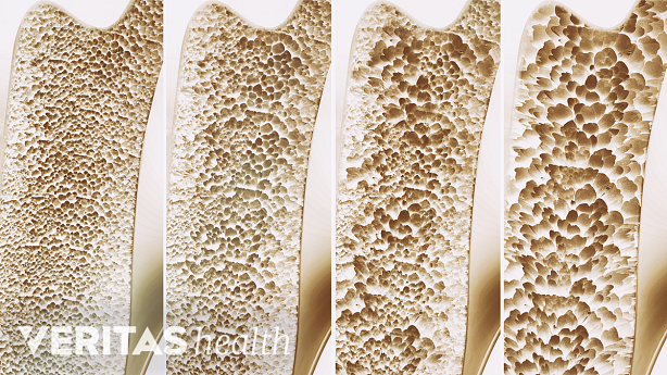 Stages of osteoporosis in bone.