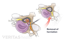 Surgical removal of the herniated part of a spinal disc that&#039;s pressing on the spinal nerves.