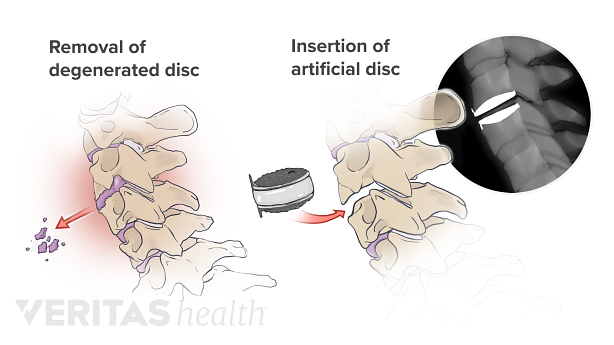 Two-part illustration showing the removal of a herniated disc and the insertion of an artificial one.