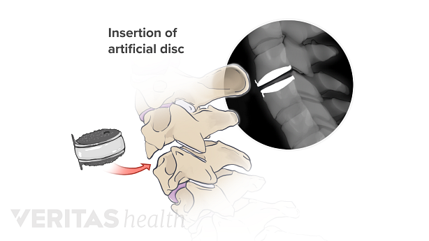 illustration showing insertion of artificial disc into the vertebra.