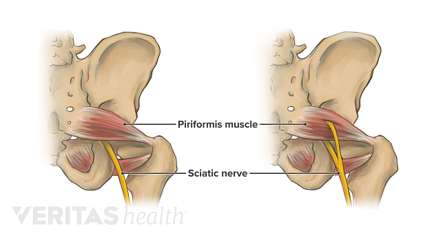 The left side of two pelvises showing the anatomic variation of the sciatic nerve as it courses below the piriformis muscle and through the piriformis muscle.