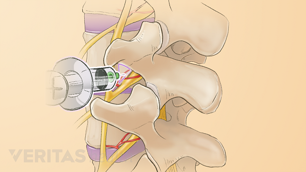 An illustration showing a adult spine with needle inserted into it.