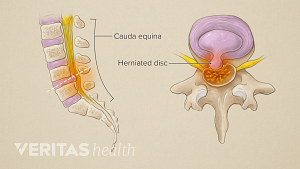 Cauda Equina Syndrome in the lumbar spine