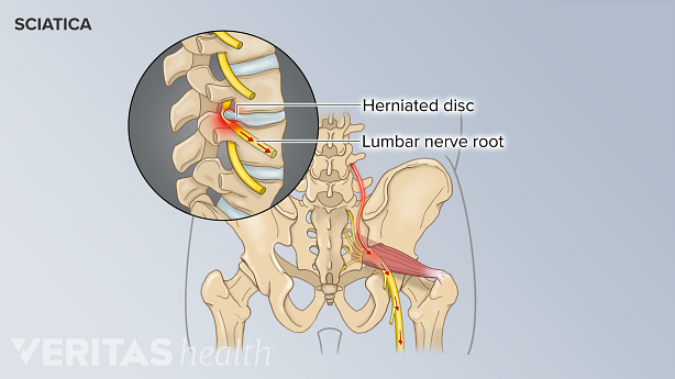 A herniated disc in the lower back compressing a nerve root and causing sciatica pain.