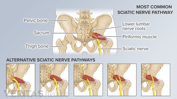 The most common sciatic nerve pathway and 5 other anatomic variations of the nerve&#039;s pathway.