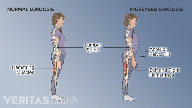 Illustration of normal and increased lordotic curves in the lower back highlighting anterior pelvic tilt and tight hamstrings.