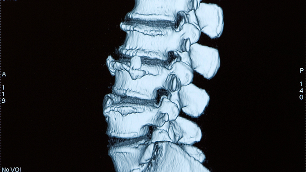 Xray of the lower spine in a side view.