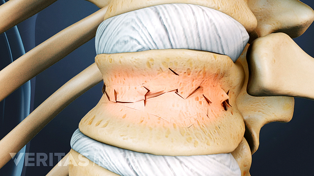 Illustration showing vertebral compression fracture.